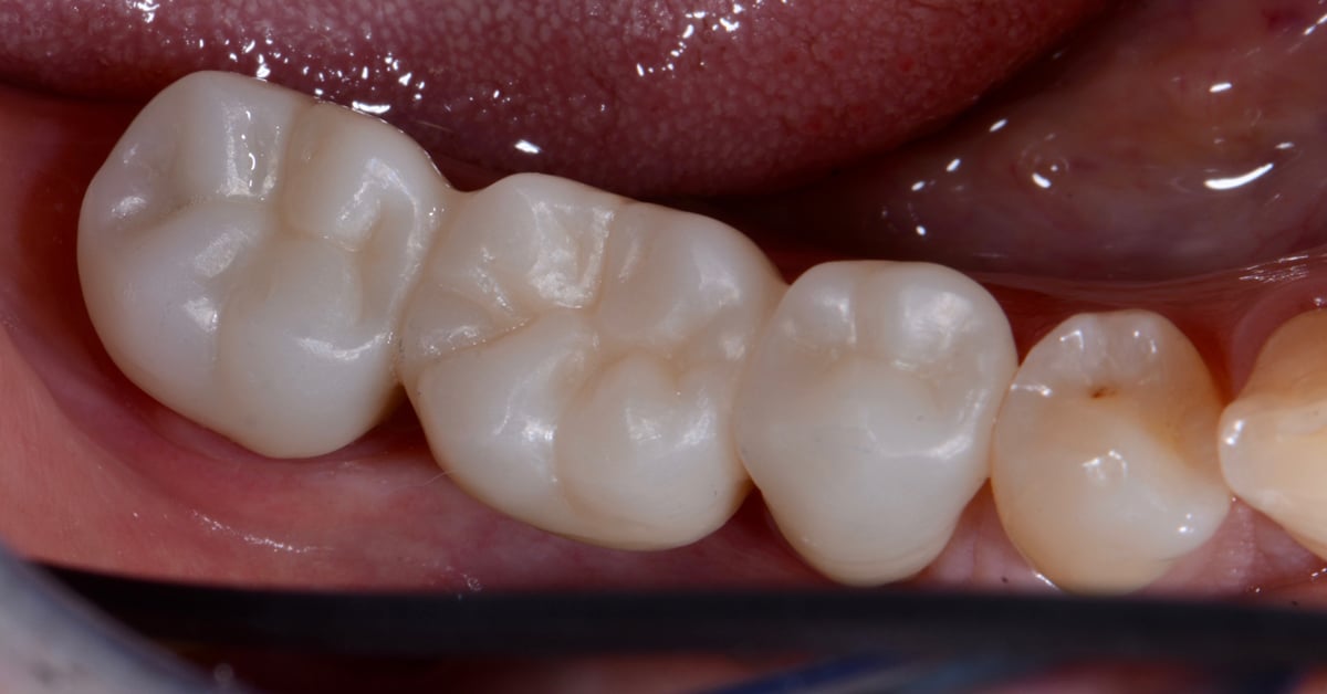 ZirCAD_Prime_NARDUCCI_Abb._1c