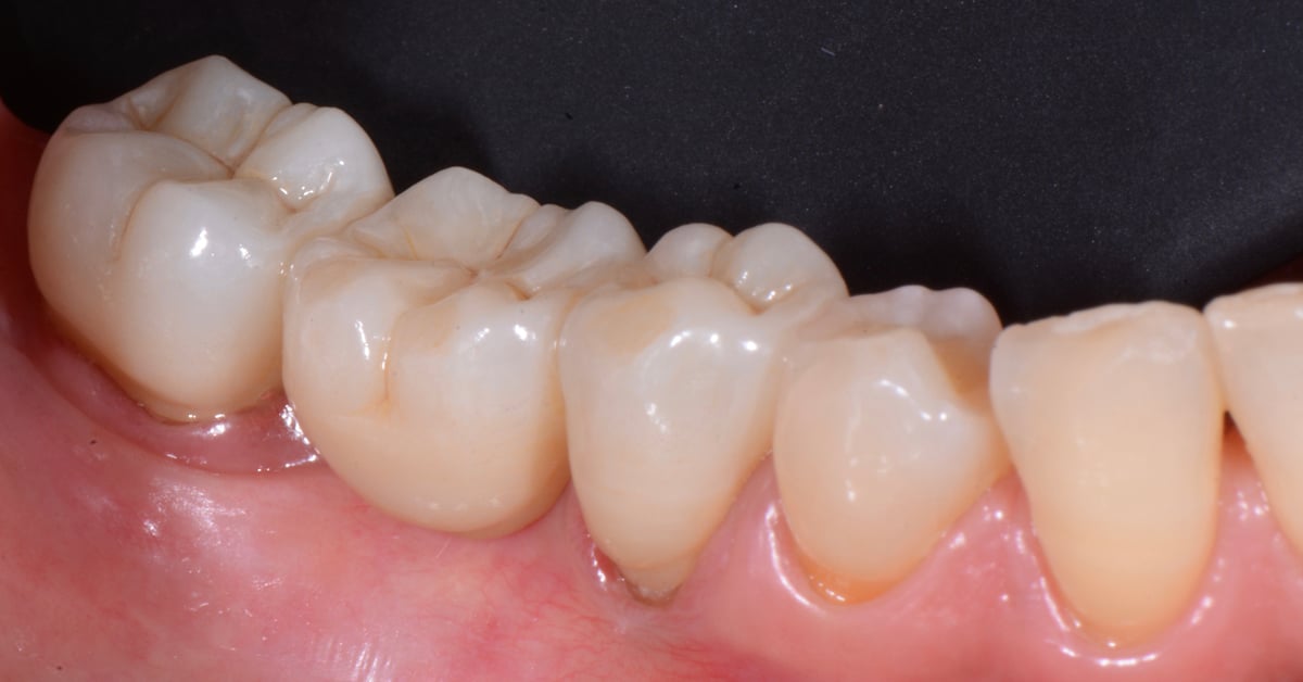 ZirCAD_Prime_NARDUCCI_Abb._1f