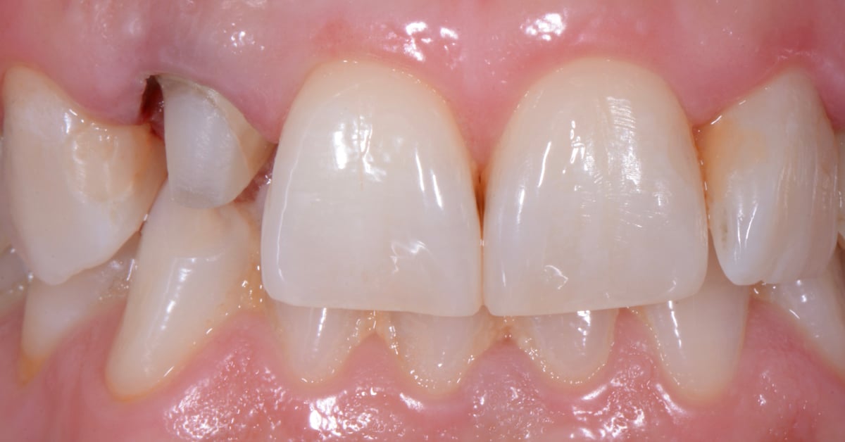 ZirCAD_Prime_NARDUCCI_Abb._2a