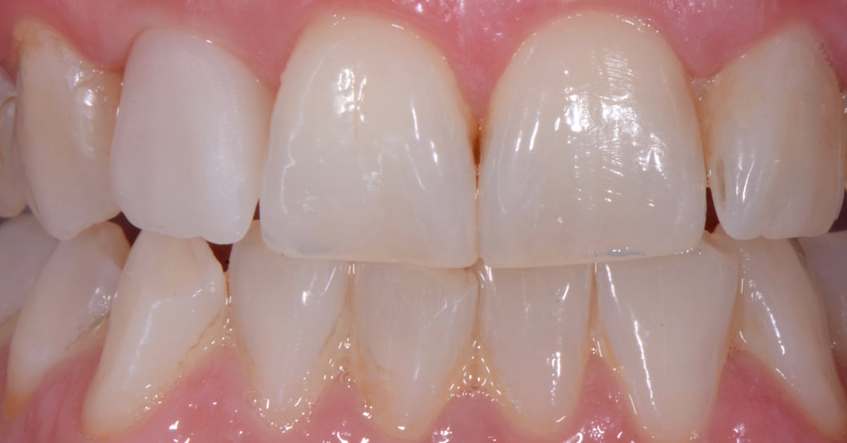 ZirCAD_Prime_NARDUCCI_Abb._2c