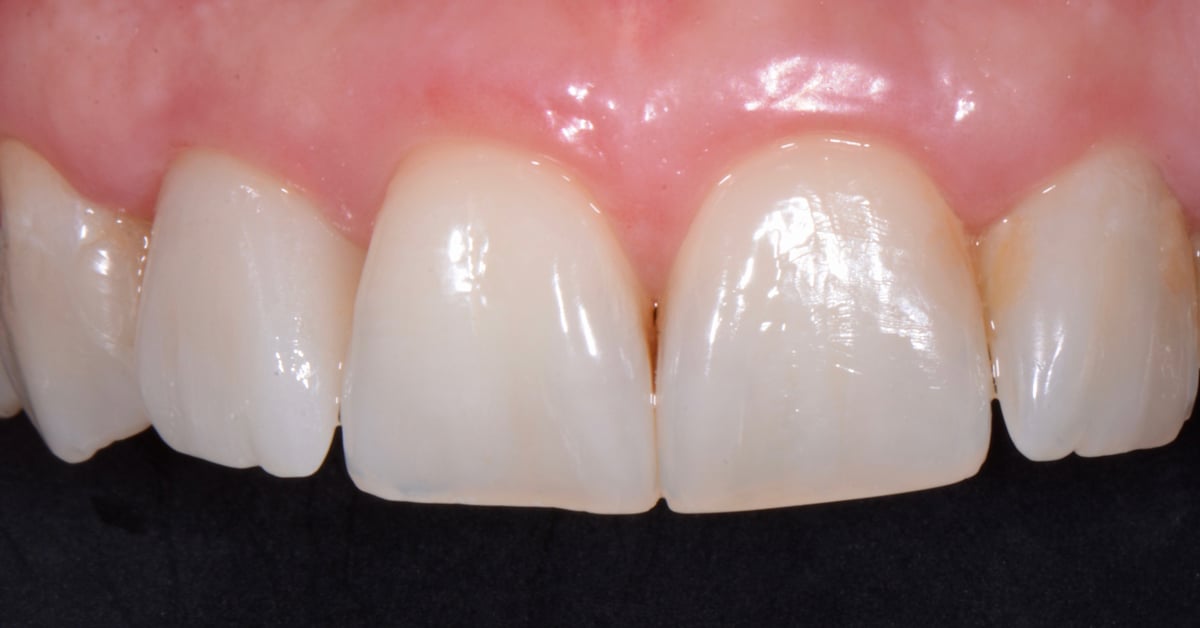 ZirCAD_Prime_NARDUCCI_Abb._2f