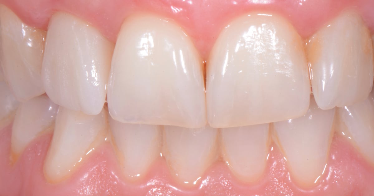 ZirCAD_Prime_NARDUCCI_Abb._2g