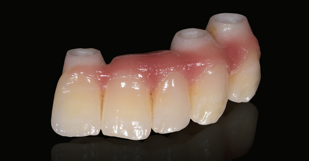 LP_ZirCAD_Prime_Fehmer_Work1