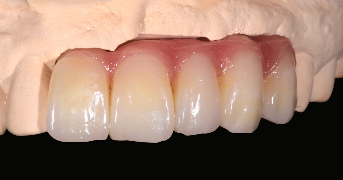 LP_ZirCAD_Prime_Fehmer_Work2