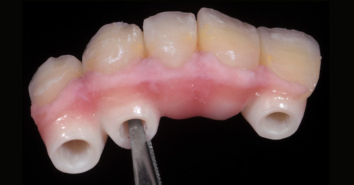 LP_ZirCAD_Prime_Fehmer_Work4