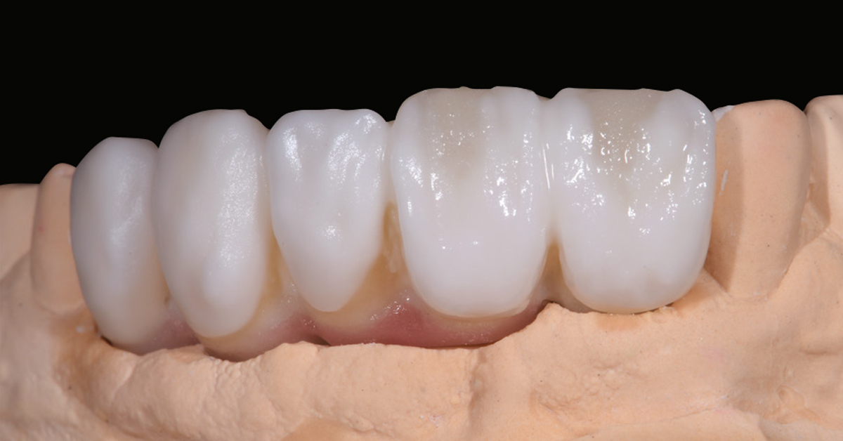 LP_ZirCAD_Prime_Fehmer_Work5